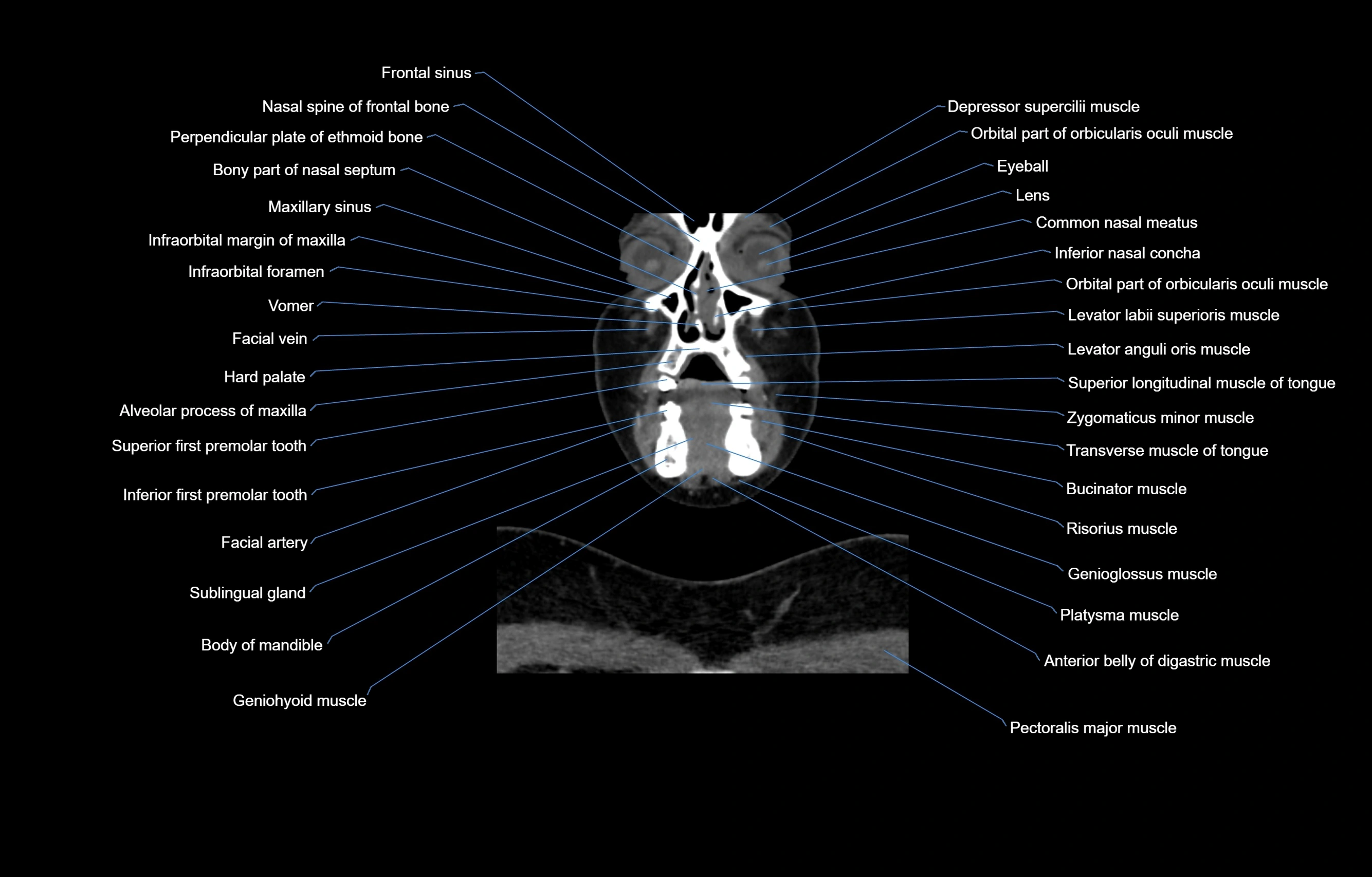 CT Neck coronal  cross sectional anatomy labelled 3D  radiology  image-00012.webp